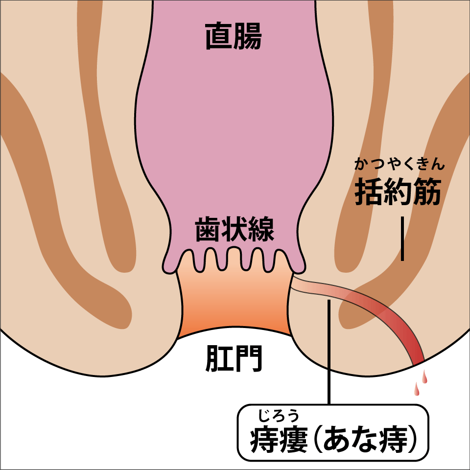 痔ろう