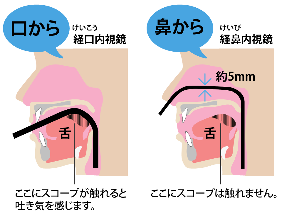 当院の経鼻胃カメラ検査